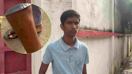 कुत्ते ने काटा तो लगा दिया सांप का इंजेक्शन! संजय गांधी अस्पताल में फिर लापरवाही के आरोप